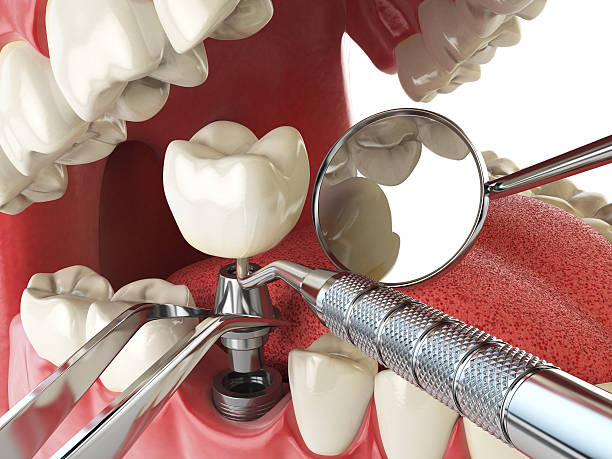 Best Emergency Dentist for Lost Fillings or Crowns in Murrells Inlet, SC