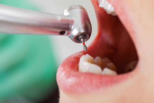 Best Emergency Root Canal Treatment in Murrells Inlet, SC